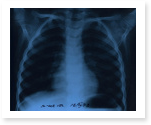 Tuberculosis Research Papers